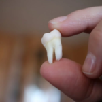 When to Remove Wisdom Teeth: Expert Advice and Warning Signs