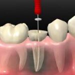 Tooth Pain Keeping You Awake? Discover the Benefits of Root Canal in Brookefield Bengaluru