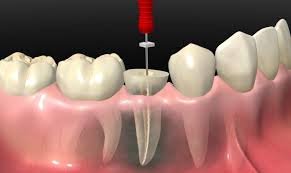 Tooth Pain Keeping You Awake? Discover the Benefits of Root Canal in Brookefield Bengaluru
