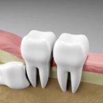 How to Manage Swelling After Wisdom Tooth Removal