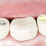 Small Cavity? How a Tooth-Colored Filling Can Protect Your Tooth