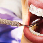 How Orthodontic Braces Correct Bite Alignment and Support Oral Health