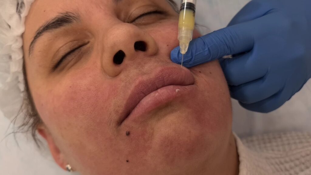 Is Restylane the Key to Smoother, Fuller Features?