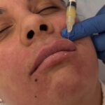 Is Restylane the Key to Smoother, Fuller Features?