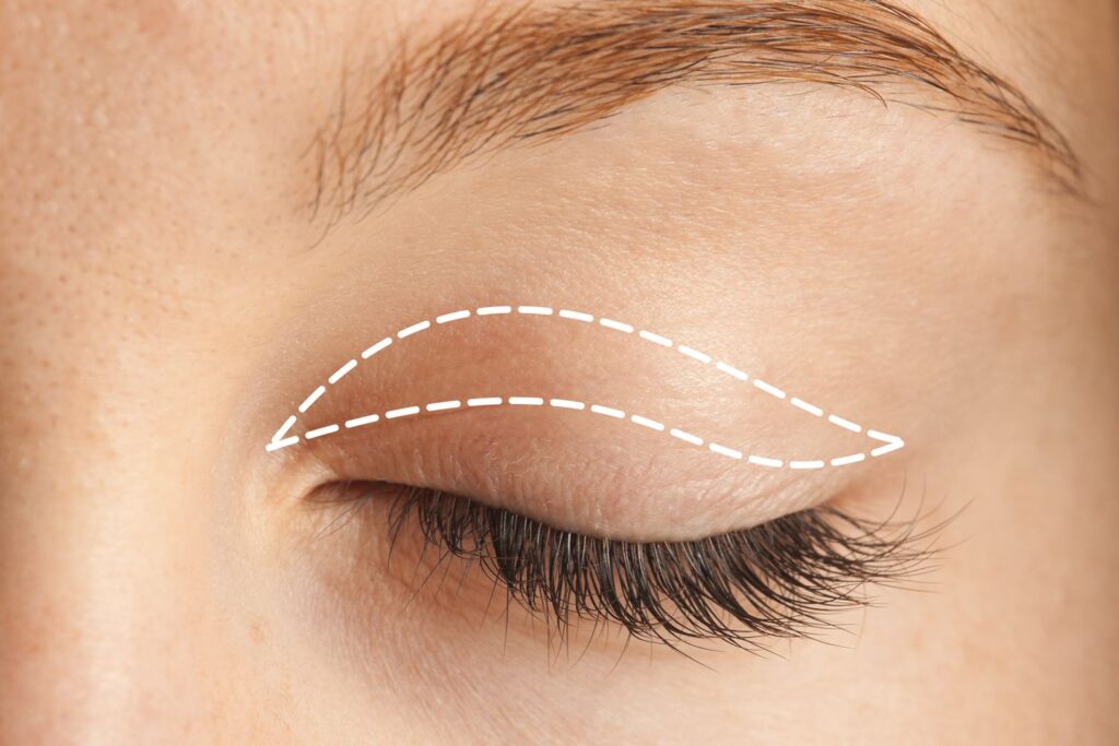 Can Blepharoplasty Improve Vision? Here’s What You Need to Know