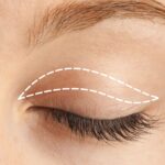 Can Blepharoplasty Improve Vision? Here’s What You Need to Know