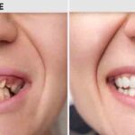 Restoring Oral Function, Comfort, and Confidence with Full Mouth Restoration
