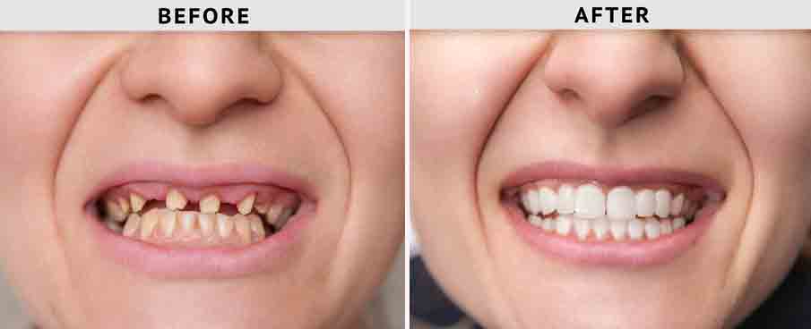 Restoring Oral Function, Comfort, and Confidence with Full Mouth Restoration