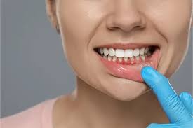 Is Gum Disease Reversible? Here’s What Dentists Say
