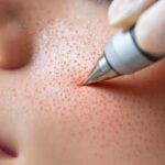 Top Benefits of Professional Microneedling Surrey Treatments
