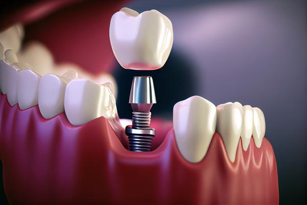 Can Dental Implants Replace Multiple Missing Teeth? Myths, Aftercare, and What to Expect Long-Term