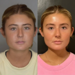 Recovery Timeline After Buccal fat removal Surgery in Dubai
