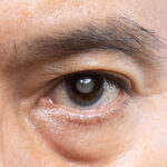 Benefits of Early Cataract Surgery for Long-Term Eye Health