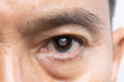 Benefits of Early Cataract Surgery for Long-Term Eye Health