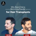 Why Beard Hair is Becoming Popular for Hair Transplants