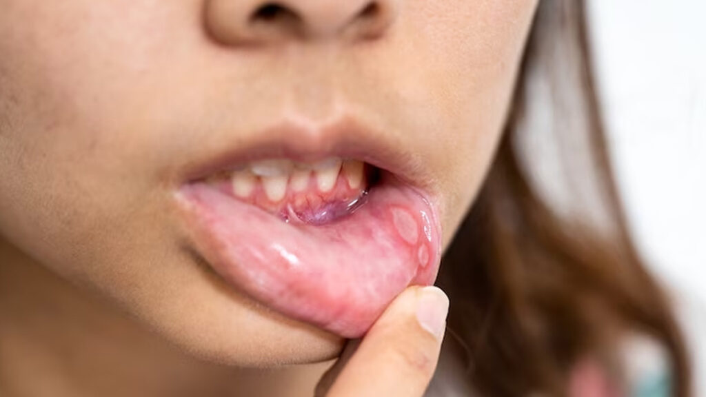 Long-Lasting Mouth Sores: Causes, Concerns, and Treatment Options Available