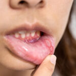 Long-Lasting Mouth Sores: Causes, Concerns, and Treatment Options Available