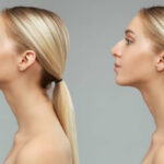 Rhinoplasty in Riyadh with Precision Tip Refinement Techniques