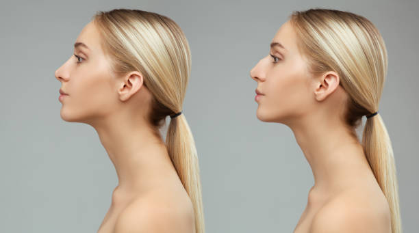 Rhinoplasty in Riyadh with Precision Tip Refinement Techniques