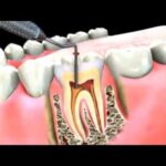 How Root Canal Treatment Saves Your Natural Teeth