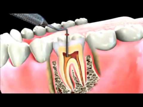 How Root Canal Treatment Saves Your Natural Teeth