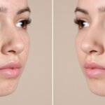 When Can You Expect Results from Scar Reduction Treatment