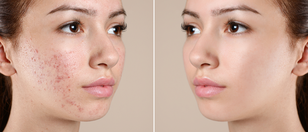 When Can You Expect Results from Scar Reduction Treatment