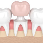 Types of Dental Crowns: Zirconia, Ceramic, and Porcelain Explained