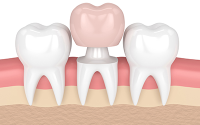 Types of Dental Crowns: Zirconia, Ceramic, and Porcelain Explained