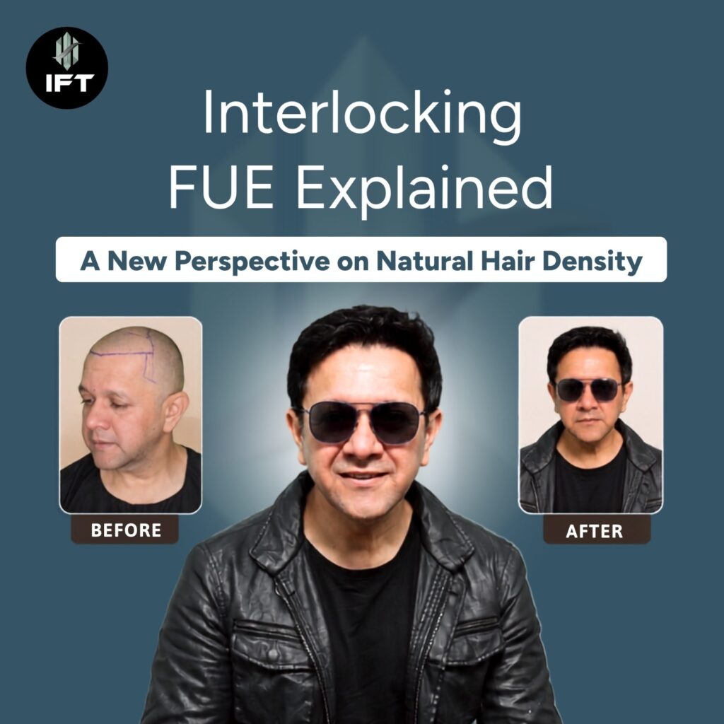 Interlocking FUE Explained: A New Perspective on Natural Hair Density