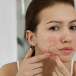 Pimples Treatment in Dubai: Comprehensive Acne Management
