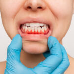 Signs You Need Professional Gum Treatment