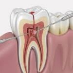 How Root Canal Treatment Can Save Your Natural Tooth