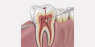 How Root Canal Treatment Can Save Your Natural Tooth