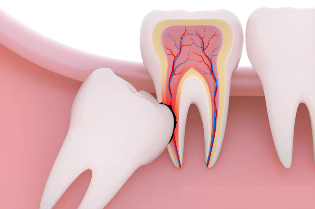 Wisdom Tooth Extraction Cost: Myths, Aftercare & Long-Term Maintenance Explained