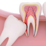 Wisdom Tooth Extraction Cost: Myths, Aftercare & Long-Term Maintenance Explained