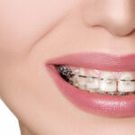 Thinking About Braces in Bhandara? Understand the Real Treatment Costs First