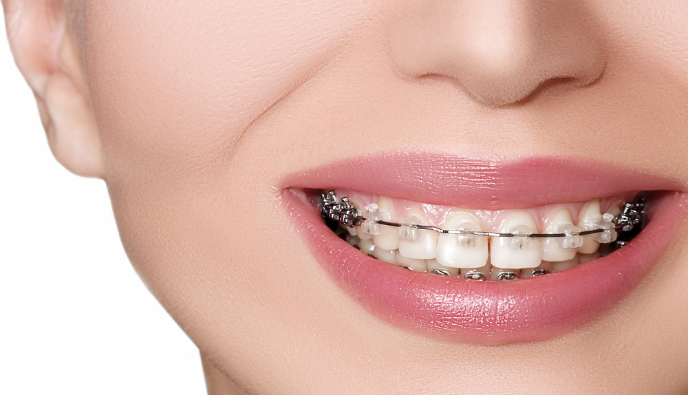 Thinking About Braces in Bhandara? Understand the Real Treatment Costs First