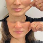 Sculptra Fillers in Dubai: Sustainable Skin Vitality