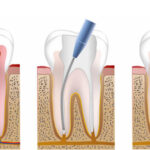 How Root Canal Treatment Helps Save Natural Teeth
