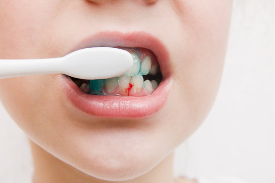 Bleeding Gums Every Time You Brush? Here’s What It Could Mean