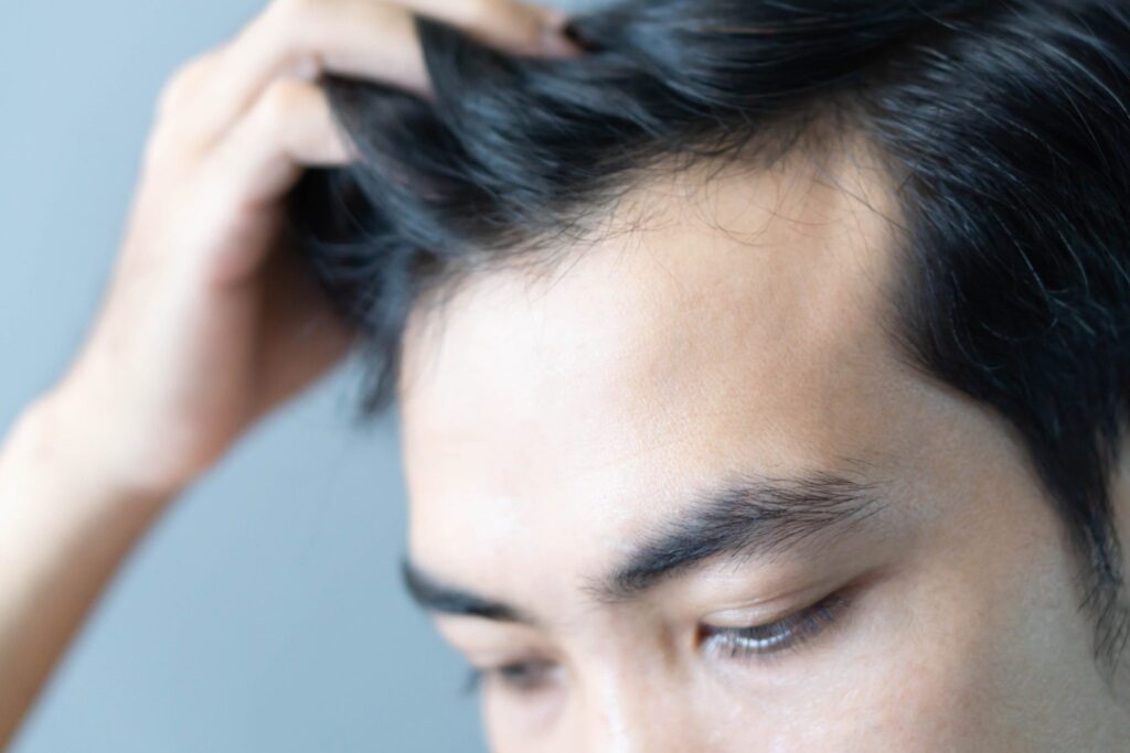 Why Are More People Choosing Regenera Activa for Hair Renewal?