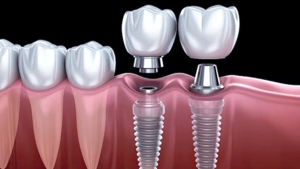 Why More Mumbai Patients Choose Affordable Dental Implants in Parel Today
