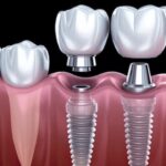Why More Mumbai Patients Choose Affordable Dental Implants in Parel Today