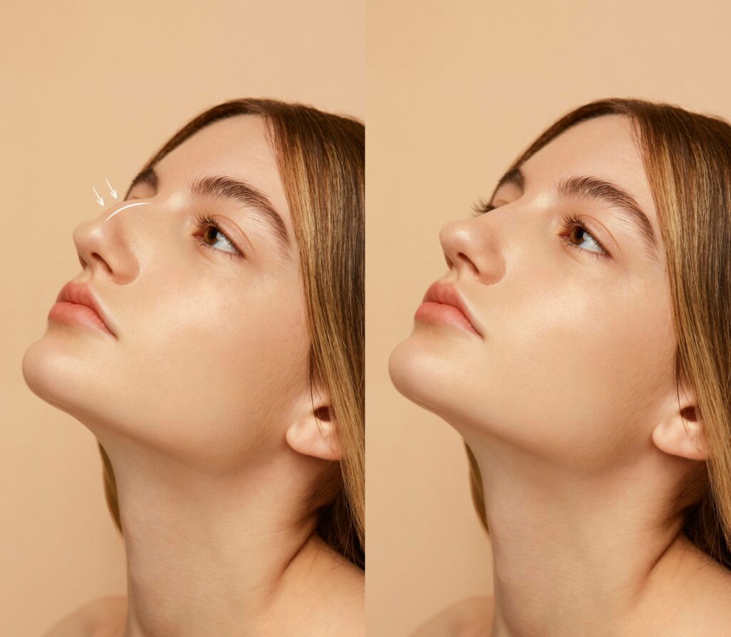 9 Realities of Rhinoplasty Before and After Transformation