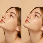 9 Realities of Rhinoplasty Before and After Transformation