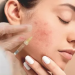 Pimples treatment in Dubai: Personalized Skin Recovery