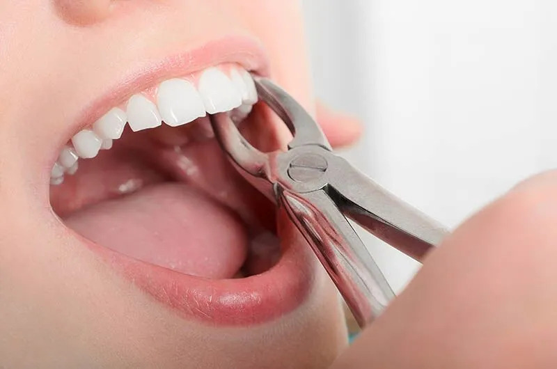 Wisdom Tooth Extraction Recovery: Healing Timeline, Best Foods & Aftercare Tips You Should Know