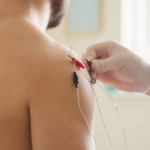 Top Benefits of Dry Needling Physiotherapy for Muscle Tightness
