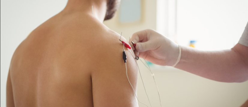 Top Benefits of Dry Needling Physiotherapy for Muscle Tightness